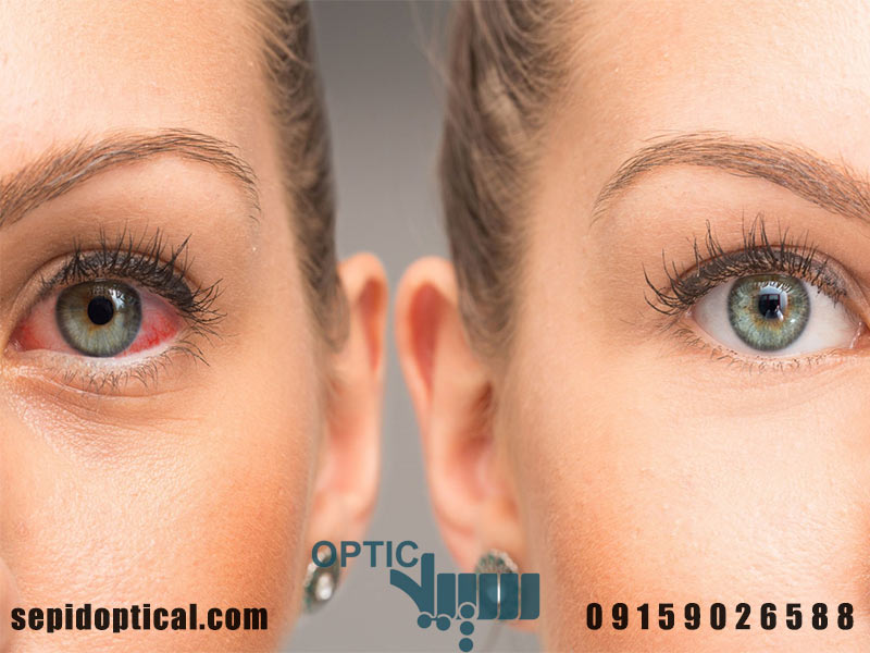 واکنش‌های آلرژیک