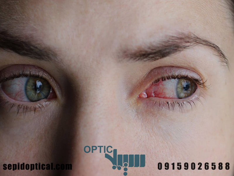 خشکی چشم و سوزش