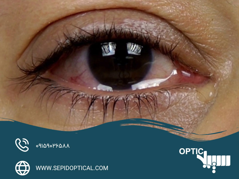 درمان‌های جراحی آبریزی چشم