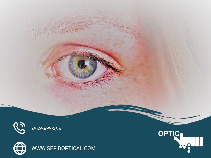 اثرات مضر نور خورشید بر چشم