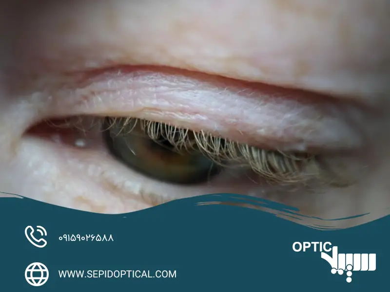 آیا درمان تنبلی چشم در بزرگسالان ممکن است؟